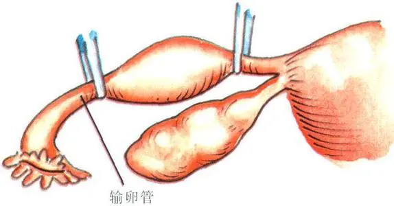 输卵管一侧切除还能怀孕吗？急！