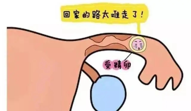 怀孕难?也许是输卵管堵塞导致的