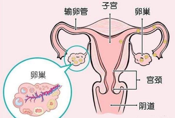 这些会引起卵巢性不孕的因素，你都知道吗?